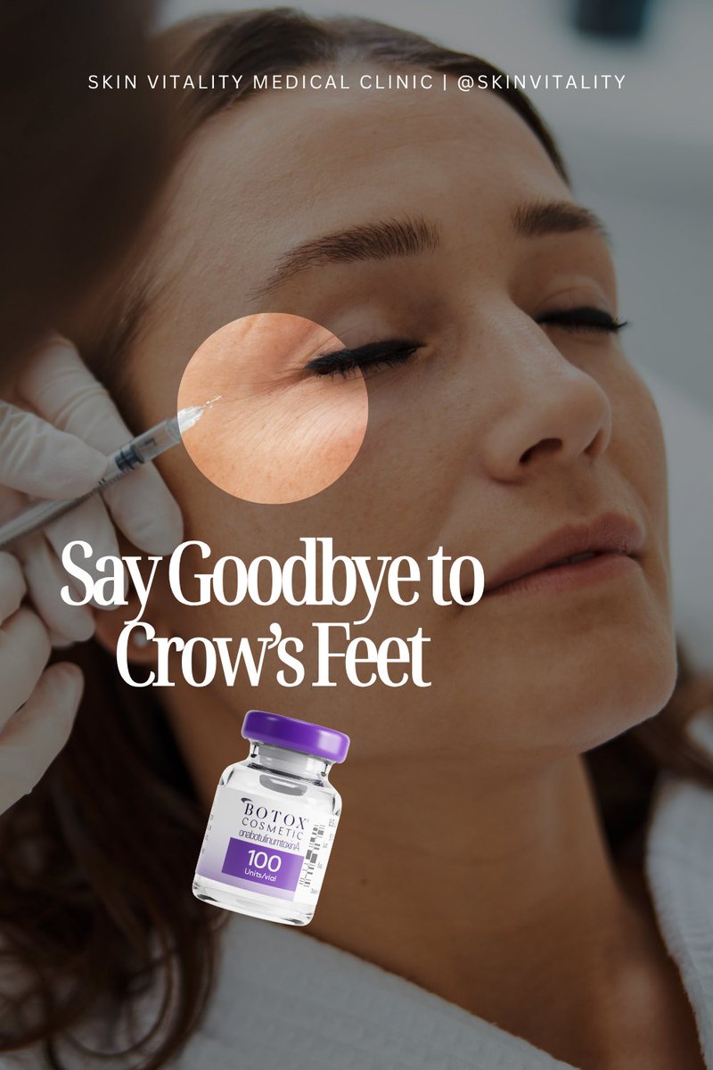 SkinVitality's tweet image. Smooth crow’s feet + fine lines with precision Botox. Refreshed eyes, natural expression, effortless confidence. 💉
#Botox #CrowsFeet #AntiAging #SmoothSkin #FacialRejuvenation