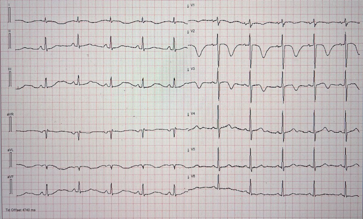 Patient intubated due to respiratory failure. What is the cause of the ECG changes