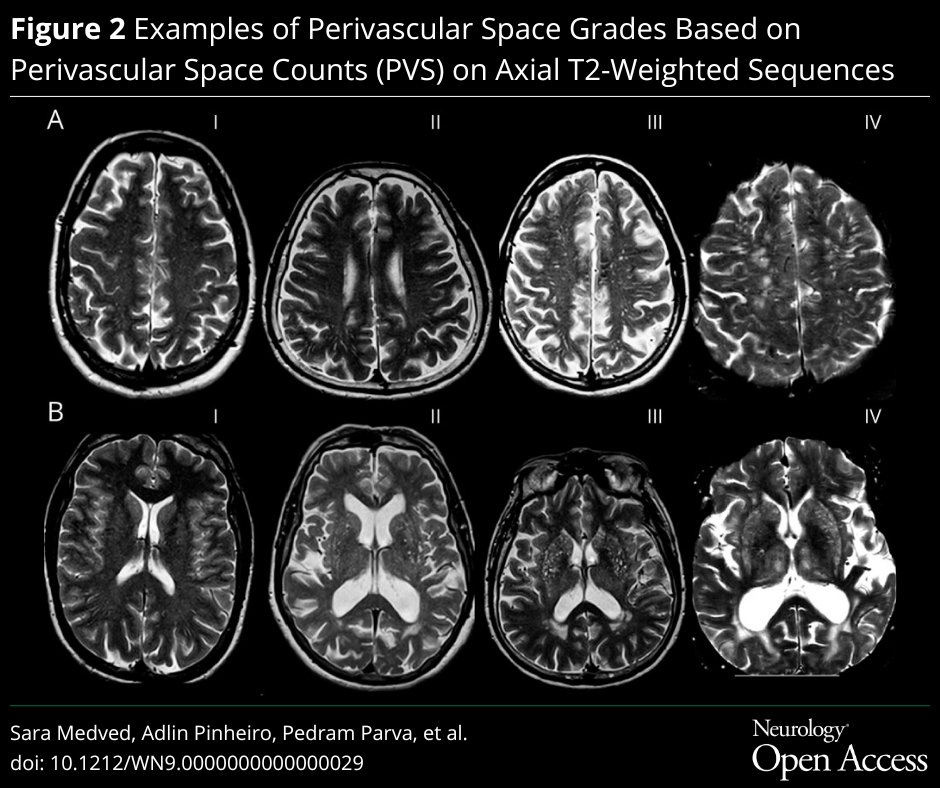 GreenJournal's tweet photo. This study in Neurology Open Access found high enlarged perivascular space burden to be associated with incident depression in a stroke-free and dementia-free community-based sample: https://t.co/jVnB4vH5b6 https://t.co/7v4bbm3p1z