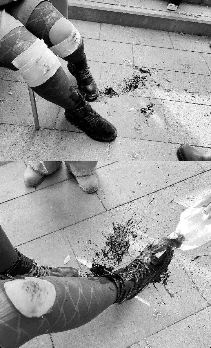 Bakın bunlar pala yarası... Bir kadın öğrencinin ayaklarına palayla vurmuşlar. AKP gençlik kolları bu teröristlere vatan sever diyor.