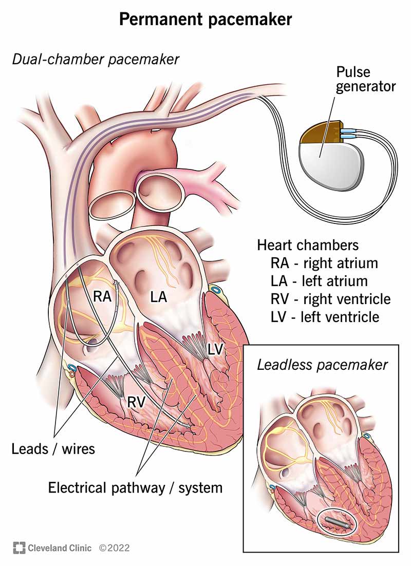 CardioNotion's tweet image. Comprender la nomenclatura de los marcapasos es básico en la práctica clínica, pero a menudo se pasa por alto🚨

En este hilo repasamos los modos de forma sencilla y con imágenes👇

#CardioNotion #pacemarker #marcapasos #ENARM #MIR #MIR2026 #2MIR26 #CardioEd