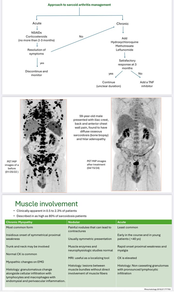 Musculoskeletal #sarcoidosis (25 %): arthritis, bone, myositis
🔹Acute: Löfgren-type, self-limited.
🔹Chronic: RA/SpA-like, dactylitis.
Lytic, reticular bone lesions
💊 NSAIDs/steroids; if chronic → DMARD ± anti-TNF #ACR25