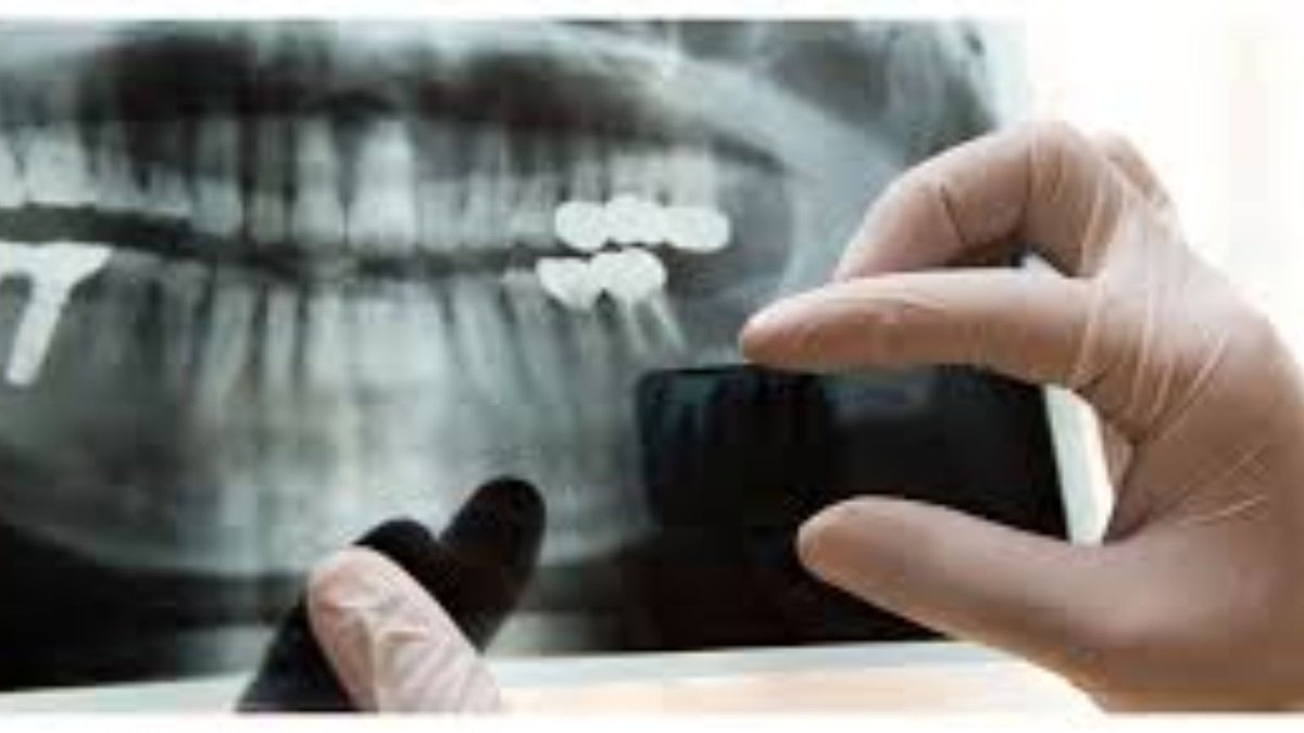 maximuspaul06's tweet image. Dental Radiographs in Scarborough help detect hidden dental issues early, ensuring accurate diagnosis and effective treatment for lasting oral health.

markhamgatewaydentistry.ca/services/digit…

#DentalCareScarborough #OralHealth #DigitalXrays #HealthySmile #MarkhamGatewayDentistry