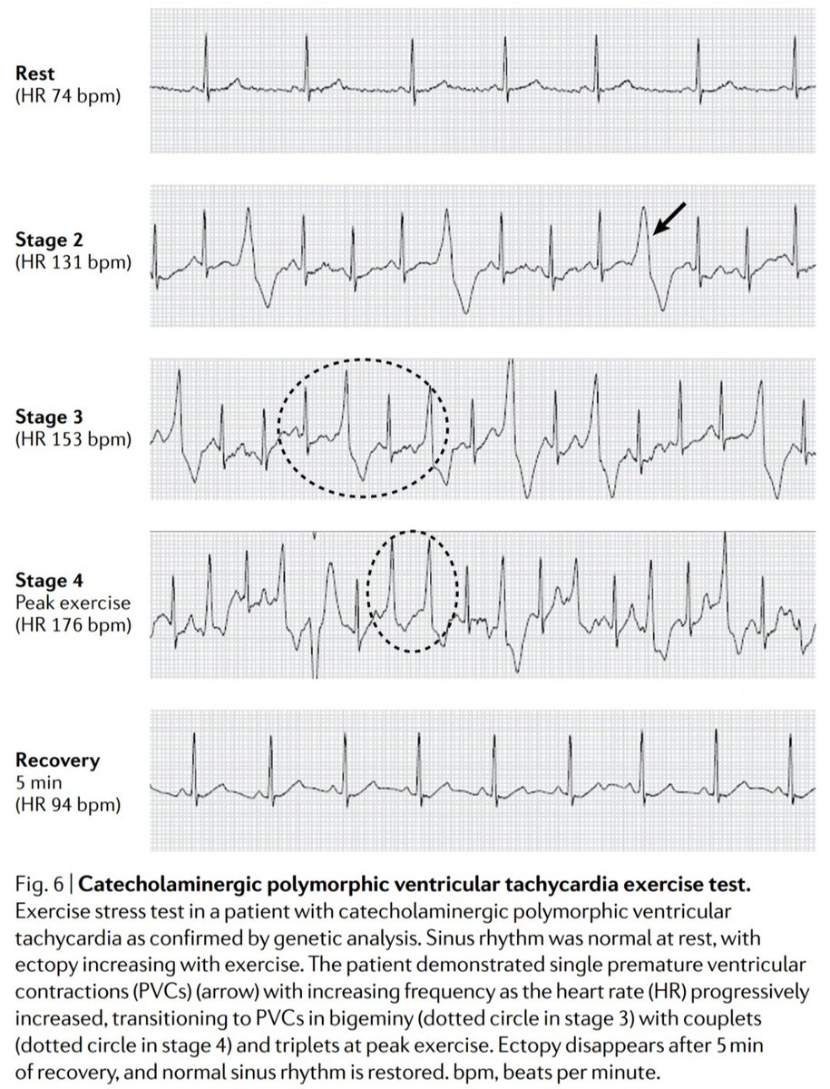 javier20ch's tweet image. Fisiopatología: Taquicardia Ventricular Polimórfica Catecolaminérgica. 🫀⚡️
🟡Las mutaciones en RYR2, calsecuestrina 2, calmodulina y triadina, conducen a una regulación anormal de la homeostasis del calcio celular. 🧬💥
🟡Esta alteración conduce a una acumulación excesiva de…
