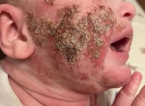This is TSW Topical Steroid Withdrawal'…

A baby is vaccine injured, they develop a condition, such as eczema. The GP precribes Topical Steroids, these stop working, staphylococcus aures infections develop. Higher potency steroids are prescribed. Damage to the enndocrine system