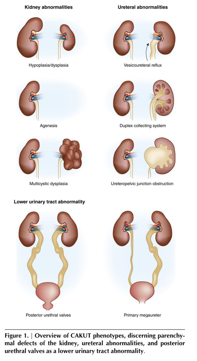 CAKUT es responsable de 15-25% de los casos de ERC en niños. 
El riesgo de pérdida de seguimiento después de la transición a Nefrología de adultos es de hasta 40%, lo que se asocia con aceleración de la ERC

DOI: 10.2215/CJN.14661119