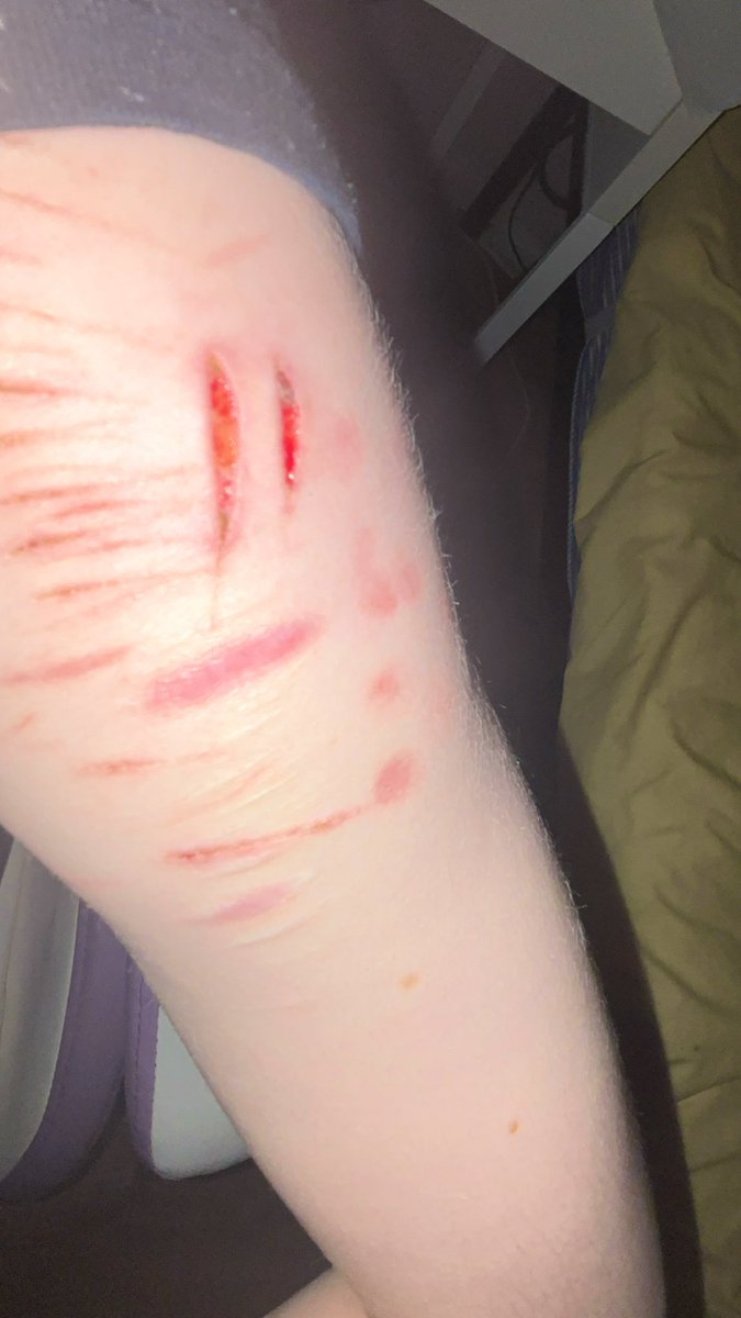 i freaking loveeee picking scabs
my fave activity yumyumyum