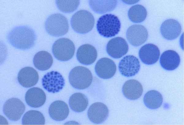 Patient with anemia and splenomegaly.

Blood smear stained with 1% brilliant cresyl blue.

What is this finding❓️

Image from 
DOI 10.1186/1750-1172-1-15
