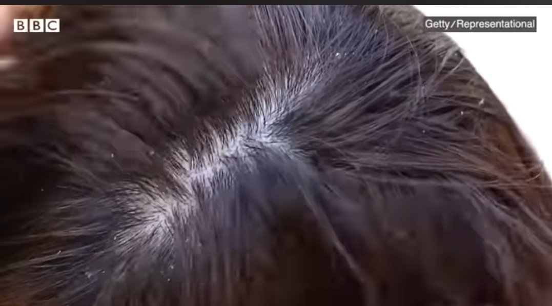 🚨 आज कल युबाओ को लगता है कि हेलमेट        
           पहनने से बाल झड़ते है 🚨

लेकिन मेडिकल एक्सपर्ट इसको नहीं मानते है
वो कहते है   ऐसा नहीं है 

 हेलमेट  गन्दा होने की बजह से वालों में  खुजली होने लगती है  
पसीना हो सकता है  लेकिन बाल झड़ते है ऐसा विल्कुल नहीं

उसको साफ करके