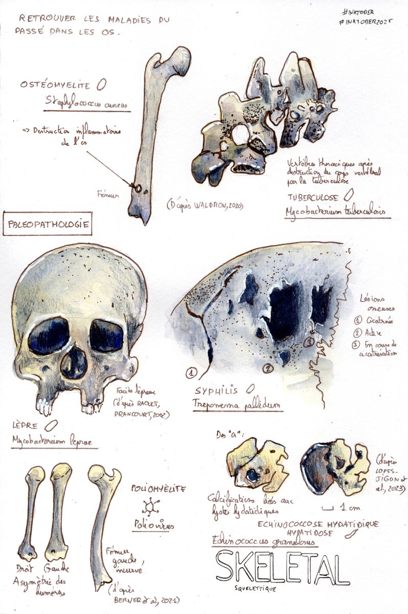 AquaTom13's tweet photo. Jour 28 - SKELETAL - Squelettique #inktober #inktober2025 #sciart #skeletal #paleopathology #bone #tuberculosis #leprosa #syphilis #polio #echinococcus https://t.co/BBNERizm9g