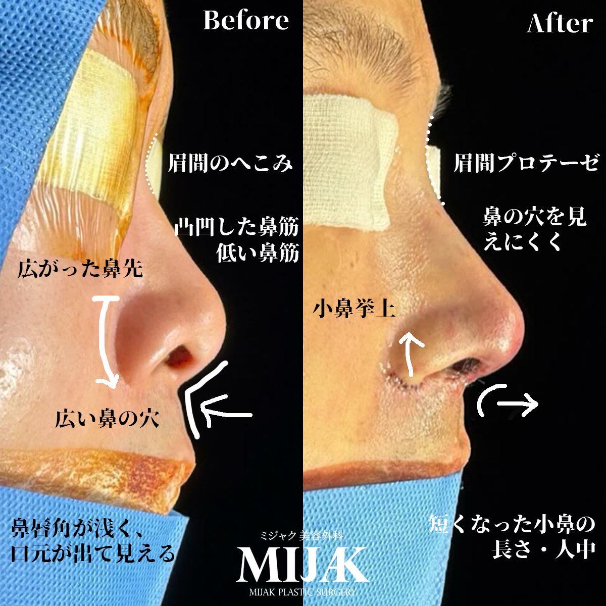 mijak_jp's tweet photo. 📌 低く広がった鼻で、口元が出て見えていたケース
眉間のくぼみ・低い鼻筋・広がった鼻先・広い鼻の穴、
鼻唇角（鼻と唇の間の角度）の陥没により、
顔の中心がぼやけて見え、口元が突出して見えていた患者様の症例です。
手術内容👇
✔ 眉間プロテーゼで鼻筋ラインを自然に連結
✔ 鼻孔縁の調整＋小鼻挙上で鼻幅を改善
✔ 鼻先矯正で広がった鼻先を整える
✔ 短く見えていた小鼻の長さと人中のバランスを調整

結果的に
➡ 鼻筋から鼻先までなめらかで立体的なラインを形成
➡ 鼻孔の幅が狭まり、改善された鼻唇角により口元の突出感が軽減
➡ 全体の印象が洗練され、自然で調和の取れた鼻ラインに✨
💎 鼻唇角・小鼻・鼻筋のバランスが、鼻整形の完成度を左右します。
自然な立体的と顔全体との調和を考慮した鼻整形
単なる高さより調和を重視いたします。

🧑🏻‍⚕️【担当医】
アン ウンモ 代表院長
🏆 拘縮鼻の再手術 No.1
🏆 中顔面短縮効果のある鼻整形技術を単独保有
#ミジャク美容外科 #韓国整形 #顔短縮鼻翼術
#拘縮鼻 #再手術 #鼻整形 #再建手術

📌 予約とお問い合わせ方法👇
💬 LINE ID：@mijakjp

🗣 日本語通訳士常駐

📍位置📍
ソウル特別市瑞草区江南大路589(蚕院洞27-2)
モルベリーヒルズメディカルタワー6階
(3号線 新盆唐線 シンサ駅 4番出口)