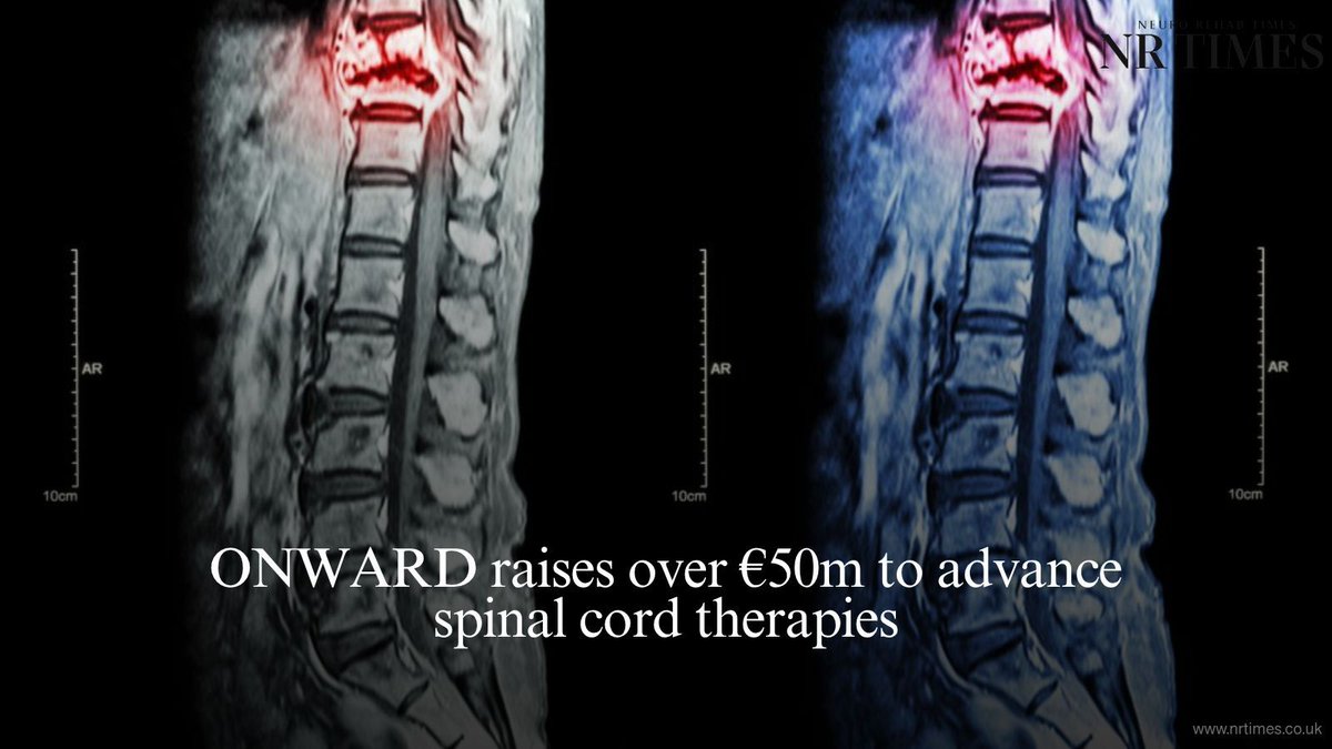 editorNRTimes's tweet image. ONWARD Medical has raised €50.85m to advance spinal cord stimulation technologies and expand commercialisation of its movement restoration systems. 

🔗 Full story:buff.ly/g9eHDiY 

#SpinalCordInjury #NeuroTech #Rehabilitation #MedicalInnovation #ONWARDMedical