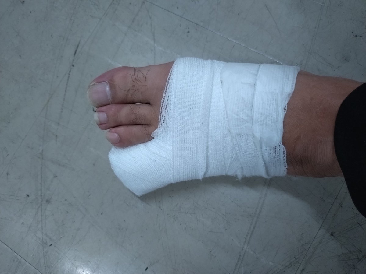 initial33a's tweet image. 昨日、仕事中にコンテナにひかれてしまい、左足小指を折ってしまいました💧
痛くはないですが、１週間はギプス固定とのことです。
労災なんですが、何もお金はでない💧
しかも、お医者さまが安静と言わないから、休ませてもらえない。
今から、深夜４連勤なのも、また容赦ない。
さて、どうするか？