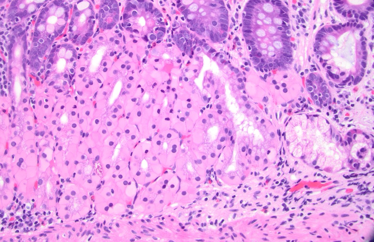 dgbrackett's tweet photo. Duodenum with weirdo Brunner glands
Glassy pink cytoplasm 
Anyone ever seen it before?
I'm guessing it's a drug / metabolic effect
#GIpath #generalpath https://t.co/xaajW7YvOU