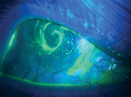 Patients who have aphakia, high regular astigmatism, or pathologic myopia, and those who are critical observers, can benefit from custom specialty soft lenses. ow.ly/1HxG50XehA1