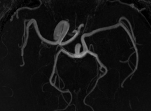 Herran_Dario's tweet image. We have all seen a carotid (fetal) origin of the posterior cerebral artery...

But what about a basilar origin of the middle cerebral artery over a homolateral carotid agenesis?

Nature never ceases to amaze us.

#NeuroTips