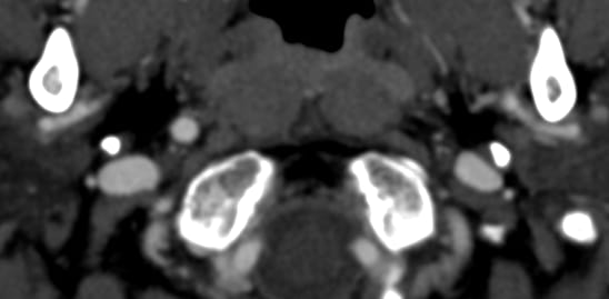 Herran_Dario's tweet image. We have all seen a carotid (fetal) origin of the posterior cerebral artery...

But what about a basilar origin of the middle cerebral artery over a homolateral carotid agenesis?

Nature never ceases to amaze us.

#NeuroTips