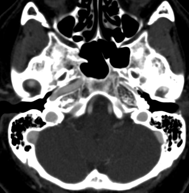 Herran_Dario's tweet image. We have all seen a carotid (fetal) origin of the posterior cerebral artery...

But what about a basilar origin of the middle cerebral artery over a homolateral carotid agenesis?

Nature never ceases to amaze us.

#NeuroTips
