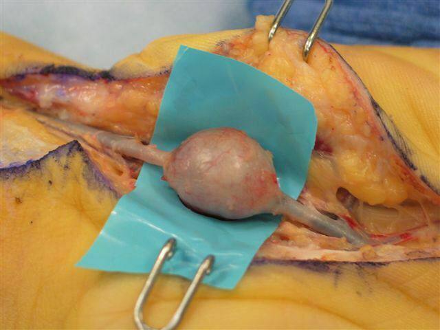 Smart1Doctor1's tweet photo. Aneurysm (bulge) of the ulnar artery
.
.
.
.
#UlnarArtery #Aneurysm #VascularHealth #HealthEducation #ArterialHealth #CirculatorySystem #MedicalAwareness #Cardiology #PatientCare #Wellness #BloodVessels #HealthRisks #PreventiveCare https://t.co/RGeF3x8r9c