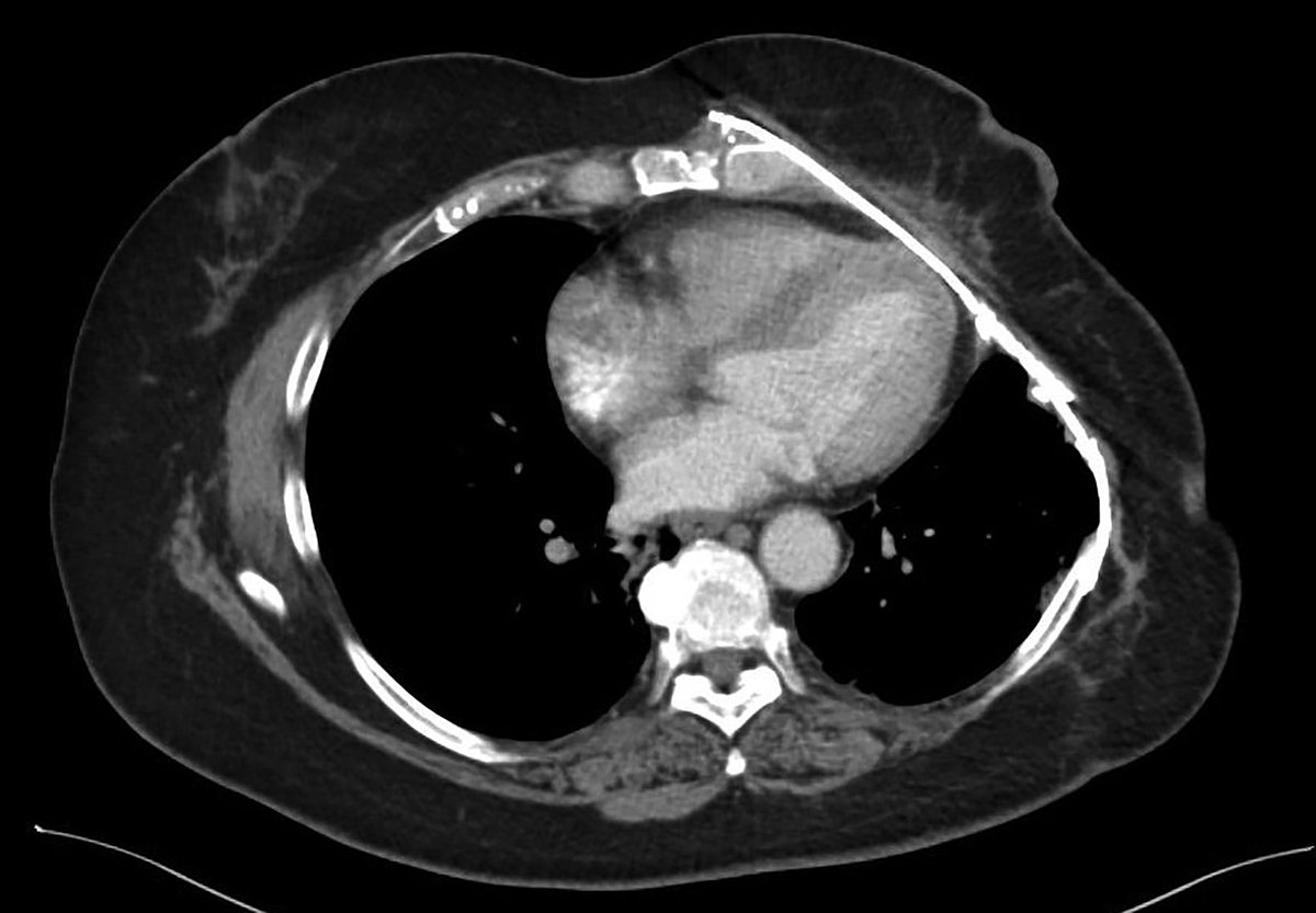 Applied_RadOnc's tweet image. Case Study: Aggressive Multimodality Therapy for Treatment of a Locally Advanced Radiation-Related Chest Wall Sarcoma
🔗 ow.ly/UnzA50XiPaa
#RadOnc #RadOncEd #CaseStudy #RadiationOncology