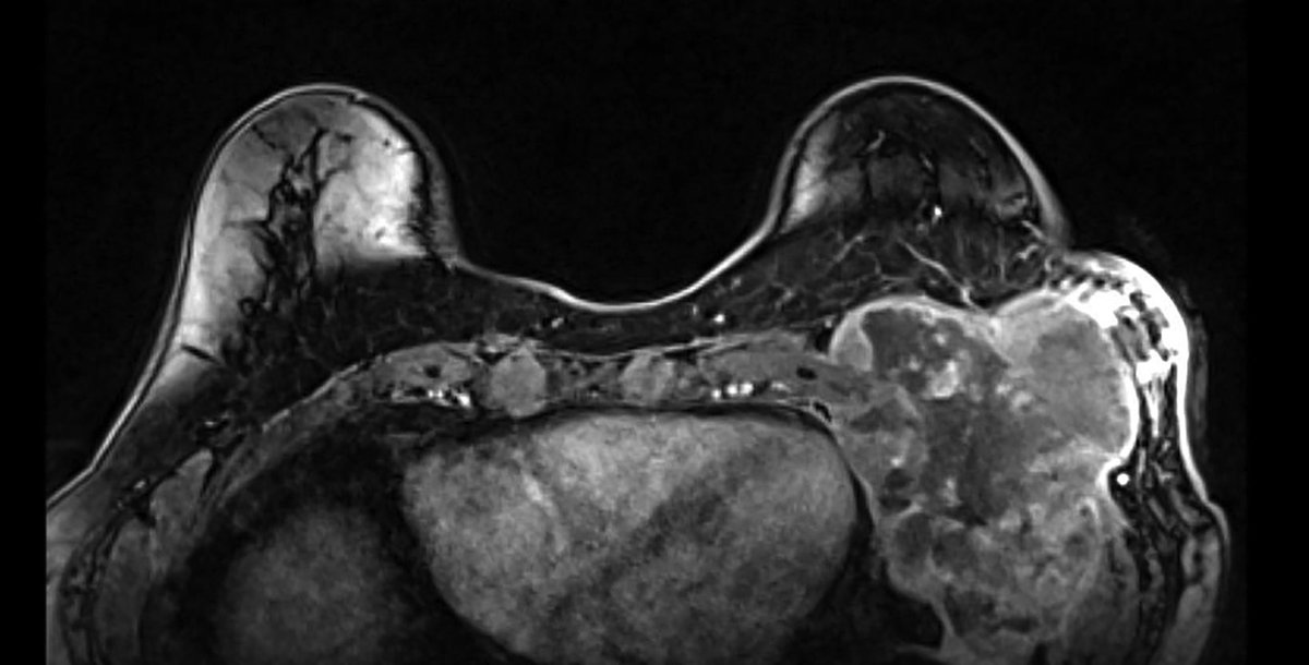Applied_RadOnc's tweet image. Case Study: Aggressive Multimodality Therapy for Treatment of a Locally Advanced Radiation-Related Chest Wall Sarcoma
🔗 ow.ly/UnzA50XiPaa
#RadOnc #RadOncEd #CaseStudy #RadiationOncology