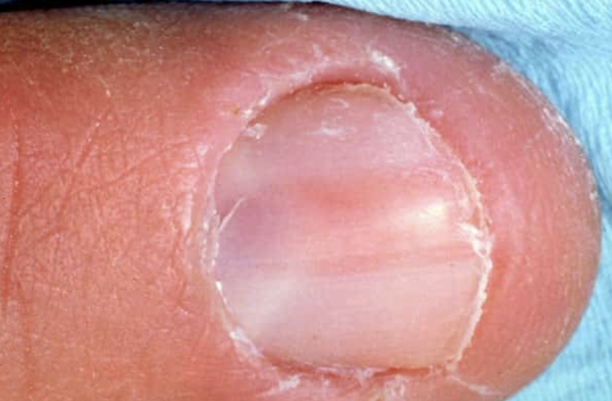DermMarianne's tweet image. Painful tumors of the skin: #BANGLE

Blue rubber bleb
Angiolipoma
Neuroma / Neurilemmoma
Glomus tumor
Leiomyoma 
Eccrine spiradenoma