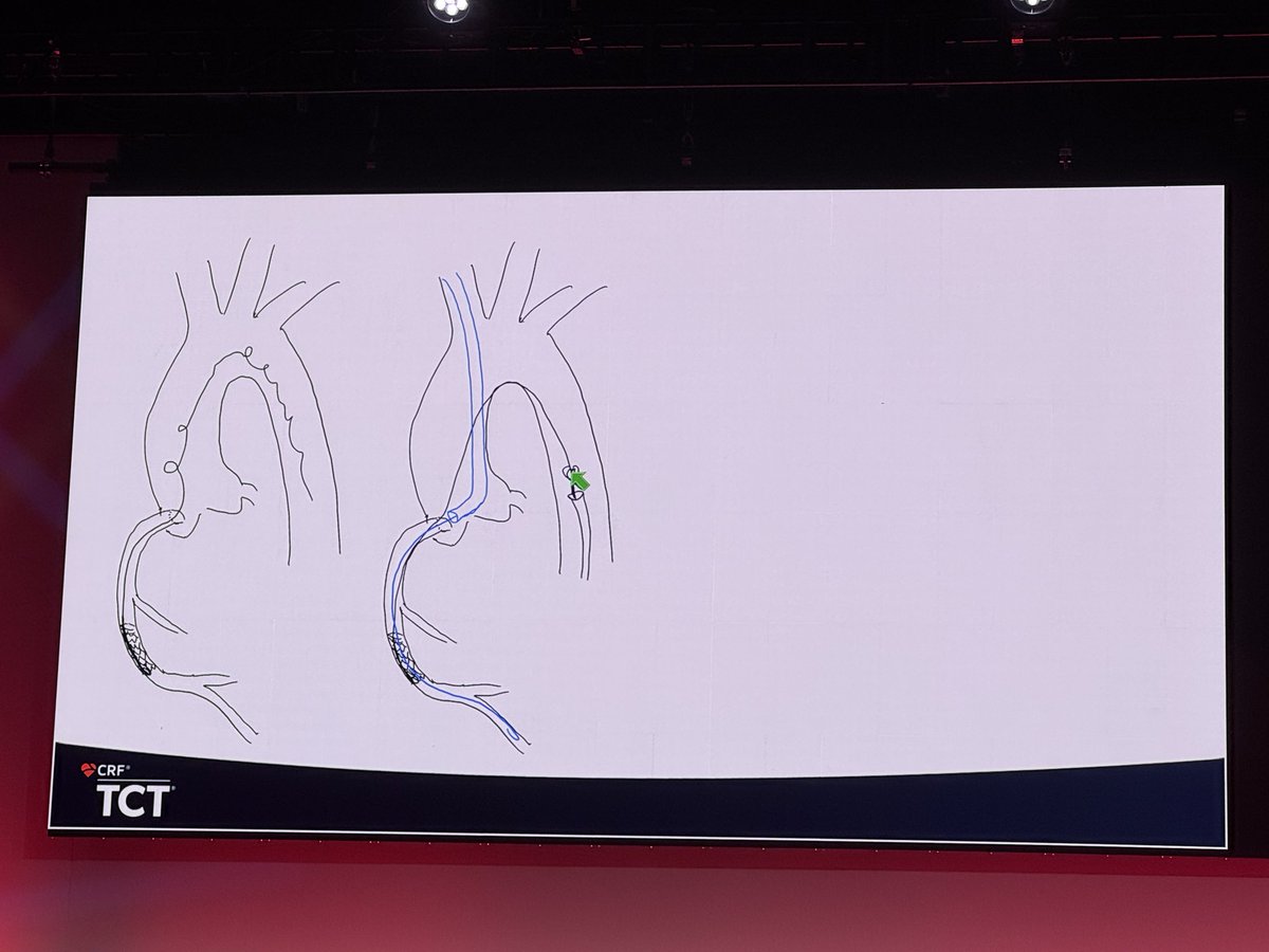 ShariqShamimMD's tweet image. Lost MC tips and unraveled wire, cut with rota!!! 

#CardioX #CardioTwitter #CardioEd #CardioResearch @BurkhoffMd @djc795 @ColletCarlos @georgedangas @jgranadacrf @MartyBLeon @Drroxmehran @sahilparikhmd @PopmaJeffrey @triciarawh @mirvatalasnag @TCTConference @TCTMD @jedicath…