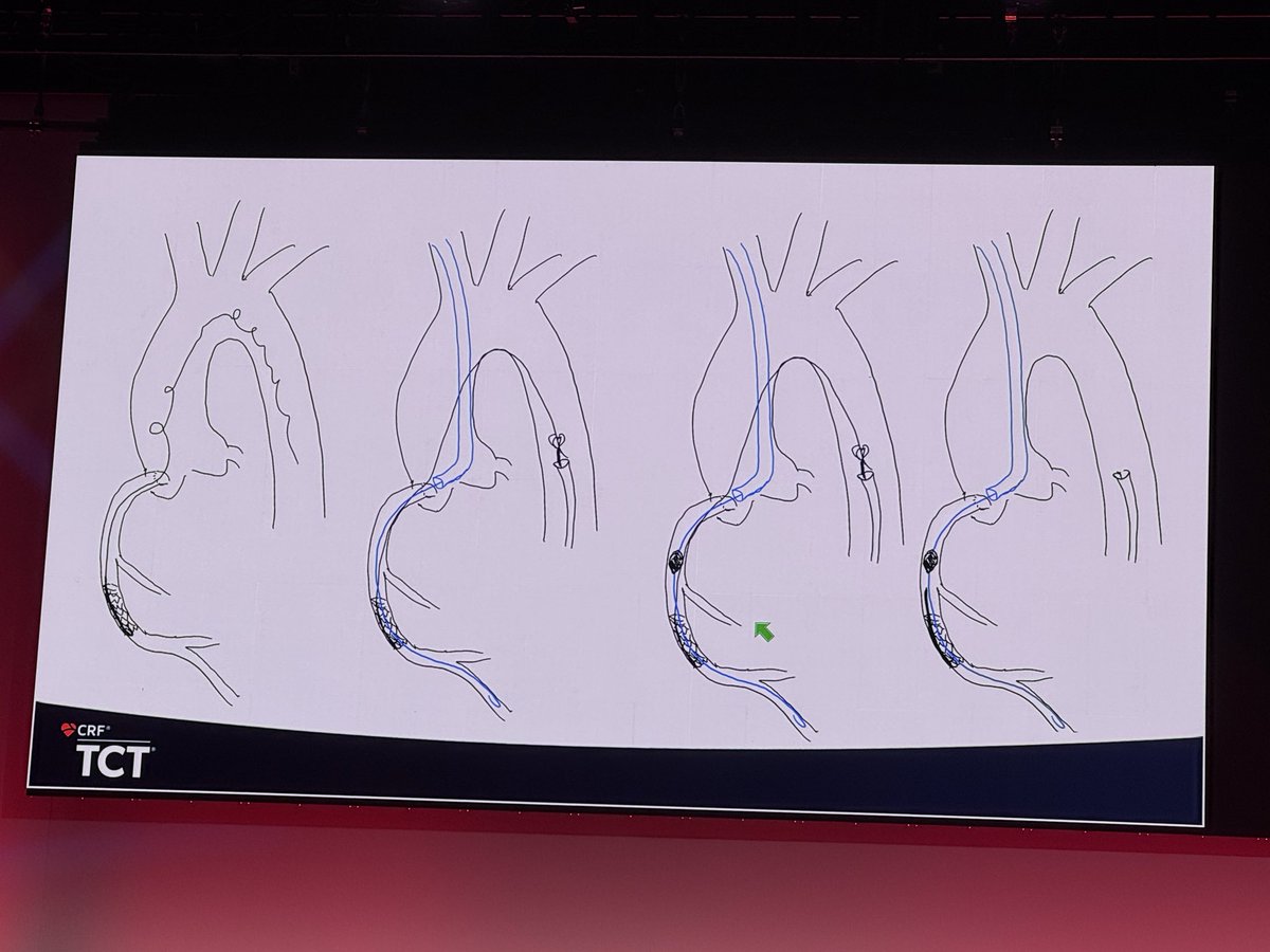 ShariqShamimMD's tweet image. Lost MC tips and unraveled wire, cut with rota!!! 

#CardioX #CardioTwitter #CardioEd #CardioResearch @BurkhoffMd @djc795 @ColletCarlos @georgedangas @jgranadacrf @MartyBLeon @Drroxmehran @sahilparikhmd @PopmaJeffrey @triciarawh @mirvatalasnag @TCTConference @TCTMD @jedicath…