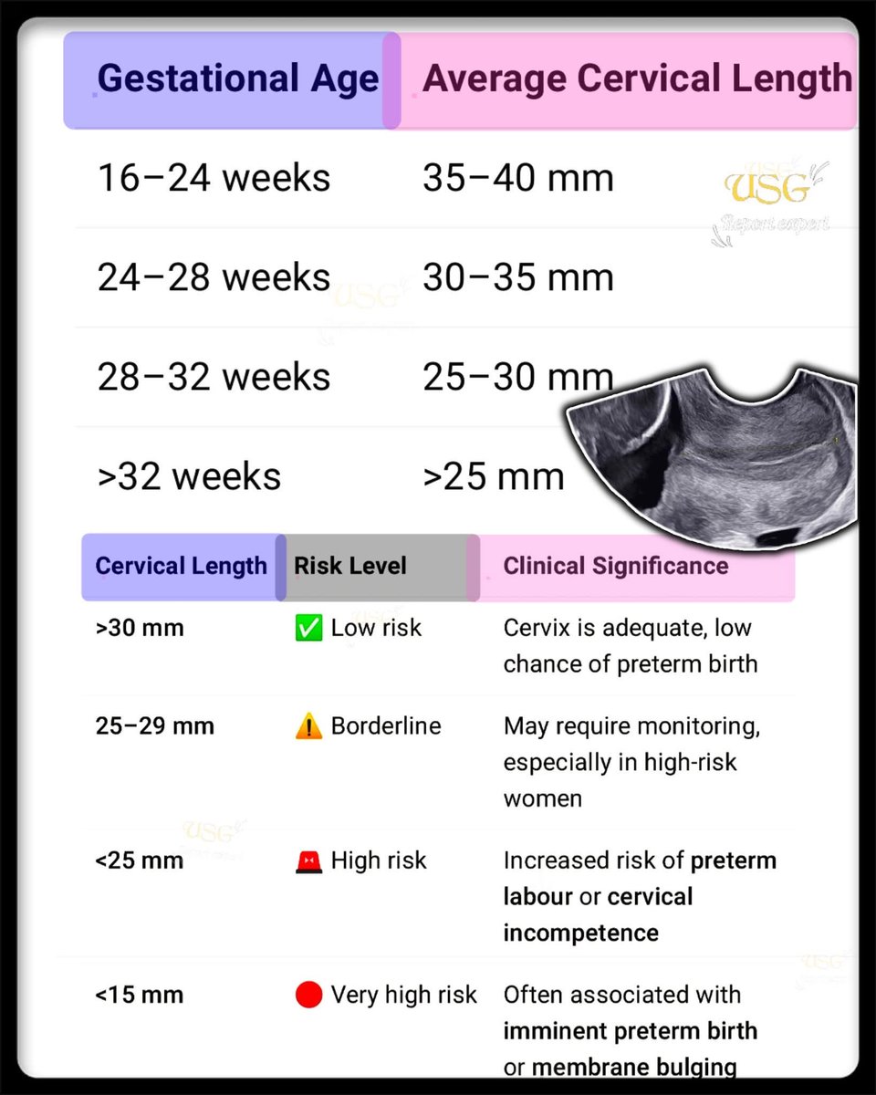 EchoTech_4's tweet image. 𝗖𝗘𝗥𝗩𝗜𝗖𝗔𝗟 𝗟𝗘𝗡𝗚𝗧𝗛 𝗜𝗡 𝗨𝗟𝗧𝗥𝗔𝗦𝗢𝗨𝗡𝗗
Normal Cervical Length : ≥25 mm   
Risk starts    : &amp;lt;25 mm   
Serious risk  : &amp;lt;15 mm   

#EchoTech