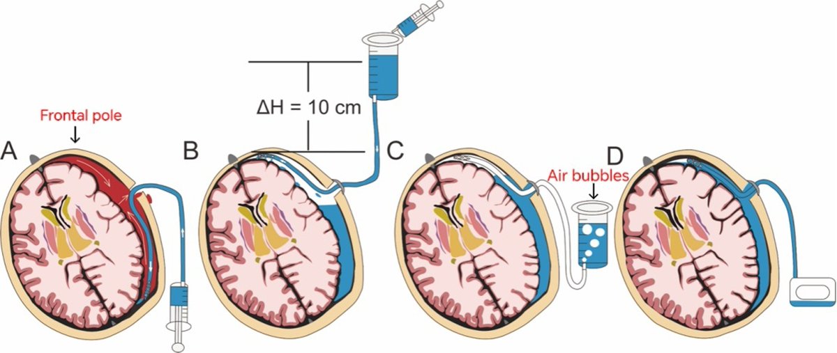 💡After burr-hole evacuation of a chronic subdural hematoma, residual air may delay brain re-expansion. A new technique replaces air with saline using gravity and hydrostatic pressure, with a single drain and no general anesthesia. Simple and effective.

doi.org/10.1016/j.neuc…