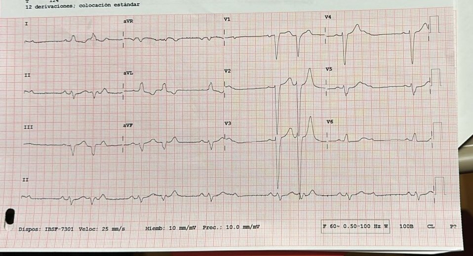 JL_MoralesArt's tweet image. What&apos;s happening here?
53 YO Male, dizziness.
#ECG #EKG #ECGChallenge #EPEEPs #Cardiology
@adribaran @SergioPinski @syamkumarmd @jeffrey_vinocur @narrowQRS @doctor_roig @UlhasDr