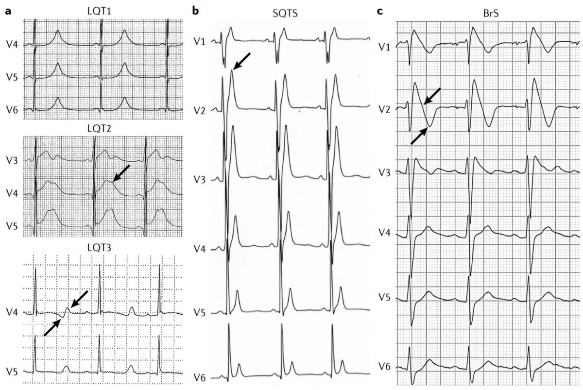 javier20ch's tweet image. Patrones EKG típicos de las principales Canalopatías. 🫀⚡️🧬
🟡SQTL1: el intervalo QT es extremadamente prolongado, con onda T alta y picuda.
🟡SQTL2: intervalo QT muy prolongado, con una muesca clara y característica en la onda T.
🟡SQTL3: intervalo QT muy prolongado que va…