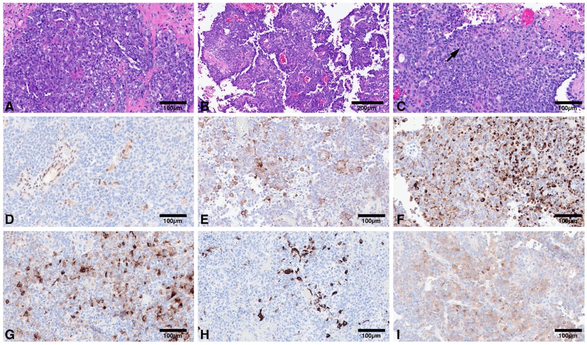 📢 #CallforReading 🏅#EditorsChoice

✨𝑻𝒉𝒆 𝑪𝒖𝒓𝒓𝒆𝒏𝒕 𝑳𝒂𝒏𝒅𝒔𝒄𝒂𝒑𝒆 𝒐𝒇 𝑴𝒐𝒍𝒆𝒄𝒖𝒍𝒂𝒓 𝑷𝒂𝒕𝒉𝒐𝒍𝒐𝒈𝒚 𝒇𝒐𝒓 𝒕𝒉𝒆 𝑫𝒊𝒂𝒈𝒏𝒐𝒔𝒊𝒔 𝒂𝒏𝒅 𝑻𝒓𝒆𝒂𝒕𝒎𝒆𝒏𝒕 𝒐𝒇 𝑨𝒕𝒚𝒑𝒊𝒄𝒂𝒍 𝑻𝒆𝒓𝒂𝒕𝒐𝒊𝒅 𝑹𝒉𝒂𝒃𝒅𝒐𝒊𝒅 𝑻𝒖𝒎𝒐𝒓✨

🔗 lnkd.in/ekTty3CY