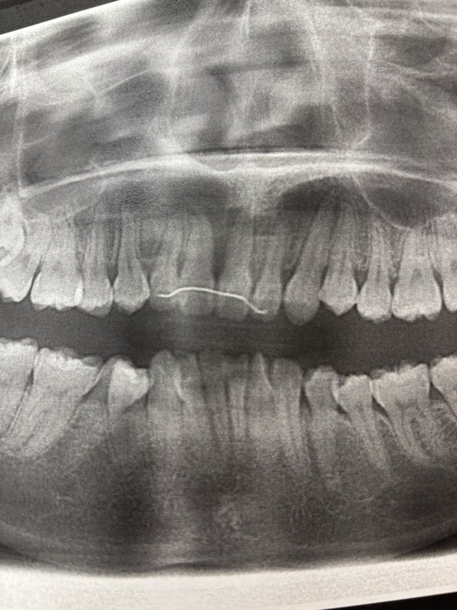 本日3周年のVtuberです！！！(クソデカボイス)

ついでに2年10ヶ月に及ぶ歯の治療も終わったVtuberです！！！！！！

知らない人もお祝いしてください！！！！！！！！！！！！
#10月のVTuberフォロー祭り