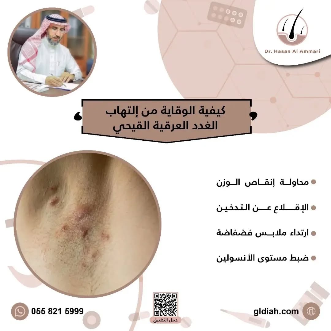 كيفية الوقاية من إلتهاب الغدد العرقية القيحي 

🔸محاولة إنقاص الوزن 
🔸الإقلاع عن التدخين 
🔸ارتداء ملابس فضفاضة
🔸ضبط مستوى الأنسولين

#غدد_عرقية #كاريزما76
#جلدية #جلدية_تجميل