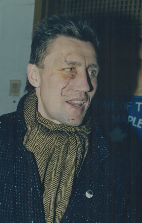 HarryHaris48861's tweet image. Borje Salming of the Toronto Maple Leafs shows the scars on his face. He got accidentally cut by Gerard Gallant of the Detroit Red Wings in 1986 and needed cosmetic surgery with over 200 stitches. #BorjeSalming #TorontoMapleLeafs #LeafsForever #Toronto #MapleLeafs #hockey 🏒 🥅