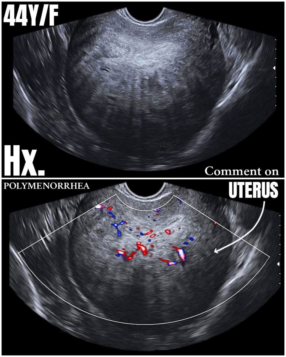 EchoTech_4's tweet image. Sonographic appearance of ??

#EchoTech