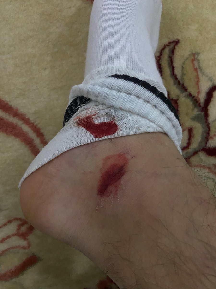 Şu amk sokak itlerini toplatın artık motorla eve dönerken ara sokağın birinde duran arabanın arkasından çıktı havlayarak aniden zıpladı ayağıma dengemi kaybettim az daha düşüp kafa üstü girecektim arabanın birine ayağımıda çizdi toplayın artık şu itleri