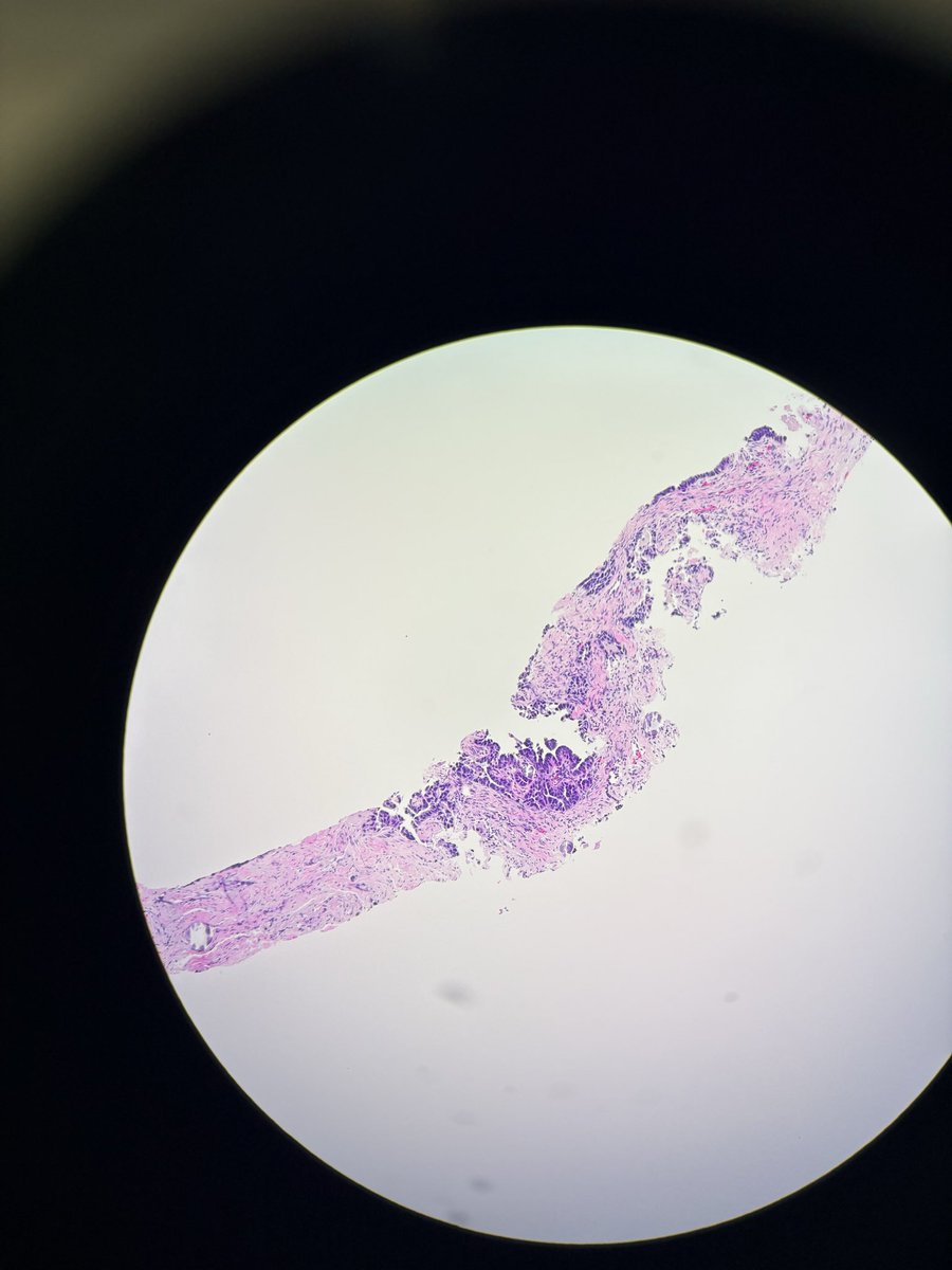 PathServerUS's tweet image. This funny looking omentum was PAN-CK +ve, CK7 +ve, CK20 -ve

87 yo with a history of pelvic mass.

What’s your diagnosis?

#pathX #PathTwitter