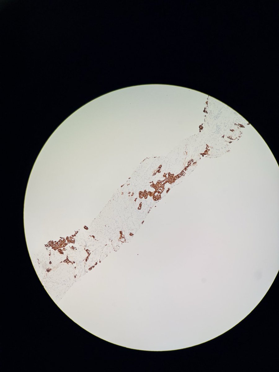 PathServerUS's tweet image. This funny looking omentum was PAN-CK +ve, CK7 +ve, CK20 -ve

87 yo with a history of pelvic mass.

What’s your diagnosis?

#pathX #PathTwitter