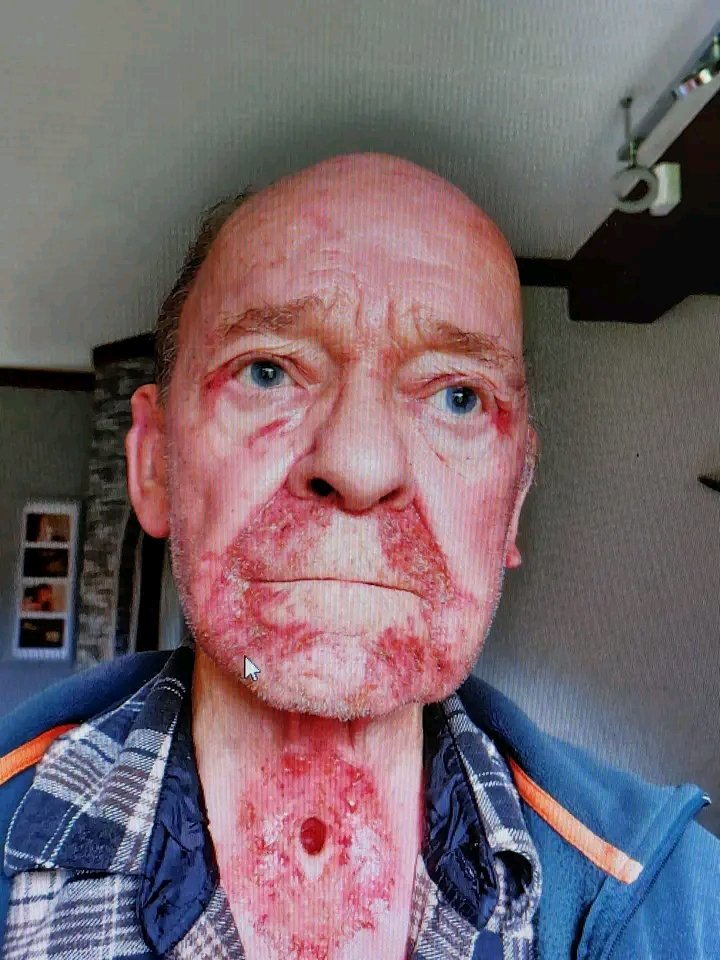 Haltecancer's tweet image. Jean MILLAU attend votre aide pour son opération...6300 Euros 

@toutlemonde
#infocancers
#cancermonde
#EuropeanUnion 
@infospourtous