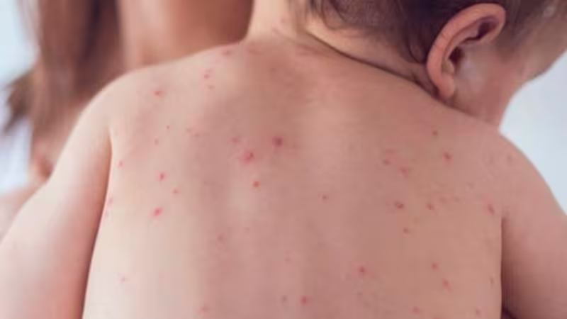 Jnlomeli's tweet photo. 1. 🦠 ¿Por qué regresó el sarampión? (II)

📉 La lectura política culpa a la 4T por el desabasto de medicinas y vacunas. Pero esa explicación está incompleta.

🧑‍⚕️ El epidemiólogo @DrCarlosAlonso y otros especialistas hablan más bien de una responsabilidad compartida.

Abro 🧵 https://t.co/JGkIoBQw2S
