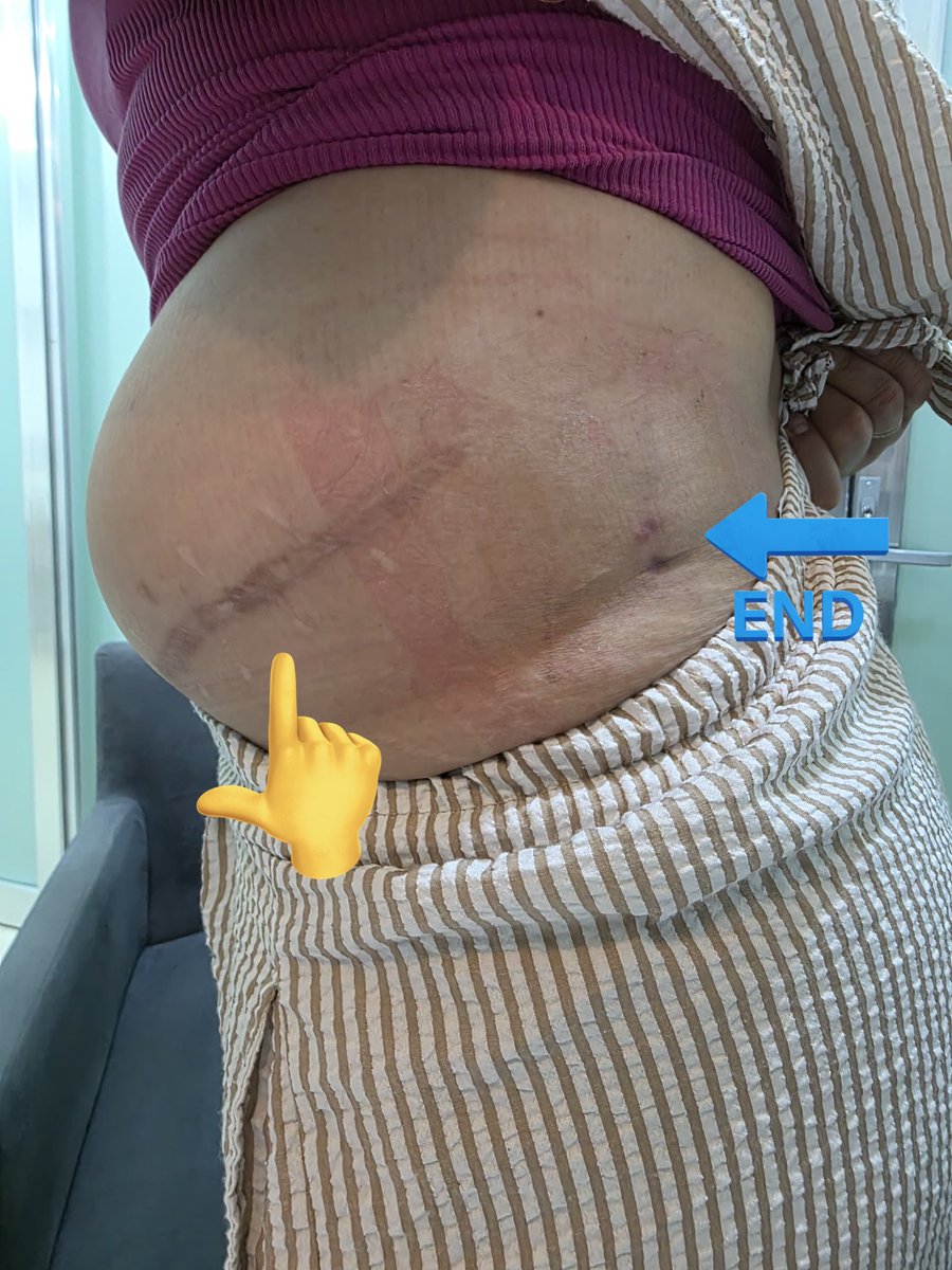 urotelio's tweet photo. La magia de la Endourología 😍

Operada hace 5 años de nefrolitotomía abierta, hizo hernia post incisional.

Tocó hacerle #Supine #MiniPCNL con 2 tractos y resolver la litiasis renal que presentó

Compartido con autorización.

@RomanCarvajal @urobraulio #UroSoMe @Endo_Society https://t.co/HL7gE65fVH