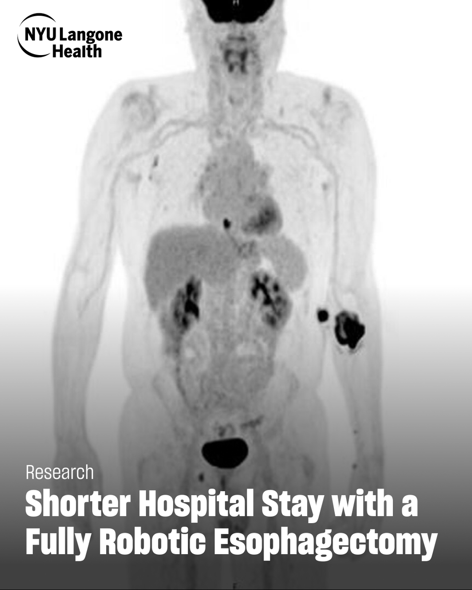 nyugrossman's tweet image. A 60-year-old patient returned to work 10 days after a robotic Ivor Lewis esophagectomy that cut hospital stay to four days.

“Across my last 40 robotic Ivor Lewis cases, I’ve had no anastomotic leaks,” says Dr. Costas Bizekis of @nyulangone.
 
Read more: bit.ly/4oKbHcX