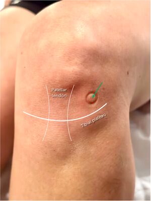 RE: knee injection for OA. “triangle technique” lateral mid-patella with knee flexed for ~90° giving ~90% accuracy.