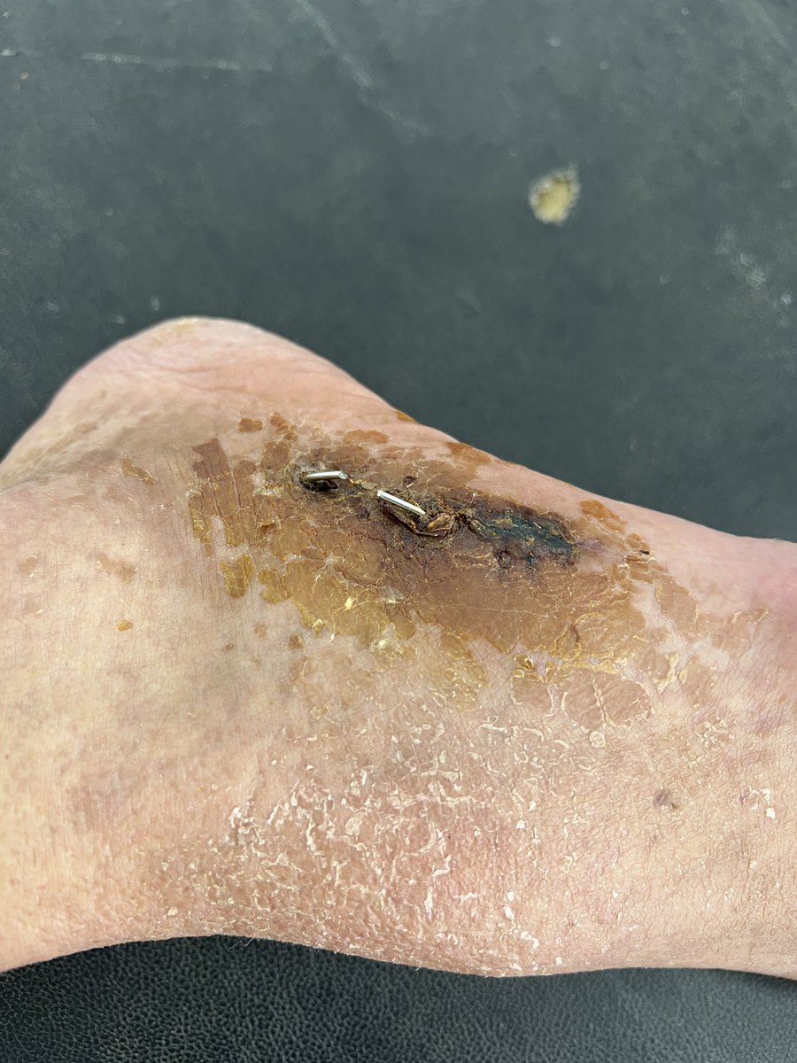 Today at the clinic, Kirschner wire removal!