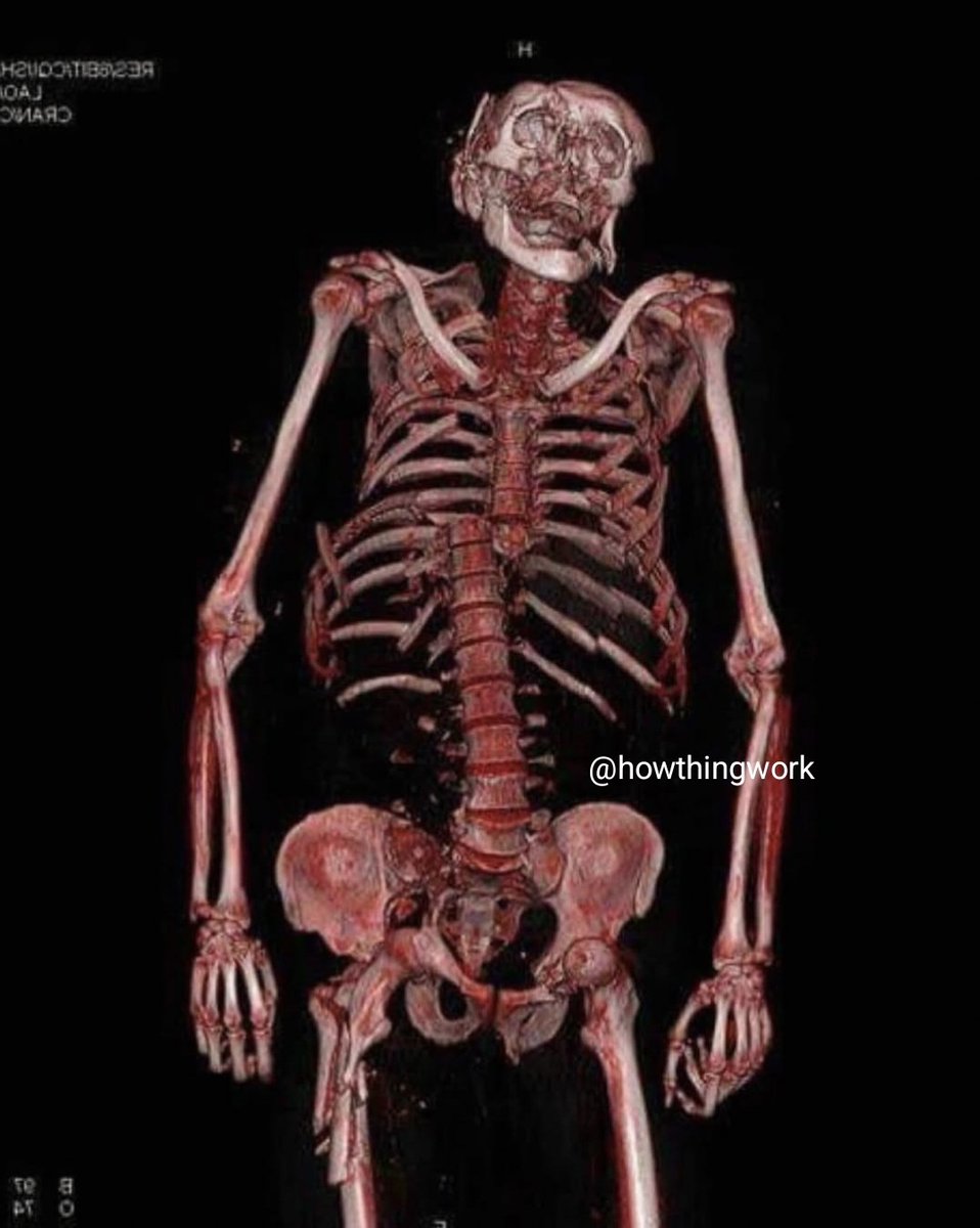 HowThingWork's tweet image. The importance of respecting the speed limit when riding a motorcycle 🚨🏍️ This 3D CT scan shows multiple fractures as the result of a motorcycle accident at high speed.