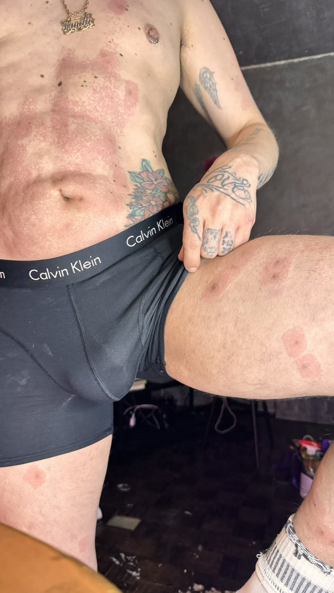 JoseRamonHerdez's tweet photo. Buenos días.!!!  Hace ocho días por fin caí en las manos de una dermatóloga excelente que me cambió la vida… llevaba años viendo a “los mejores” tratando de entender que pasaba y por fin respiré cuando sin tener idea ni de que era la psoriasis ni el término dermatitis atopica… me sentí tan feliz de solo saber. 
Los brotes han sido de unos meses para acá terribles, el día de la consulta me puso láser en cada “herida” ya que todas o casi todas estaban infectadas y así justo estaba hace 9 días..