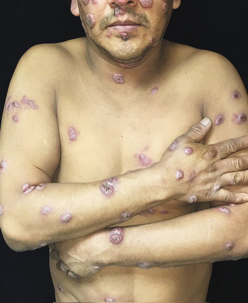 DrAkhilX's tweet image. Patient with fungal pneumonia.

What is it❓️