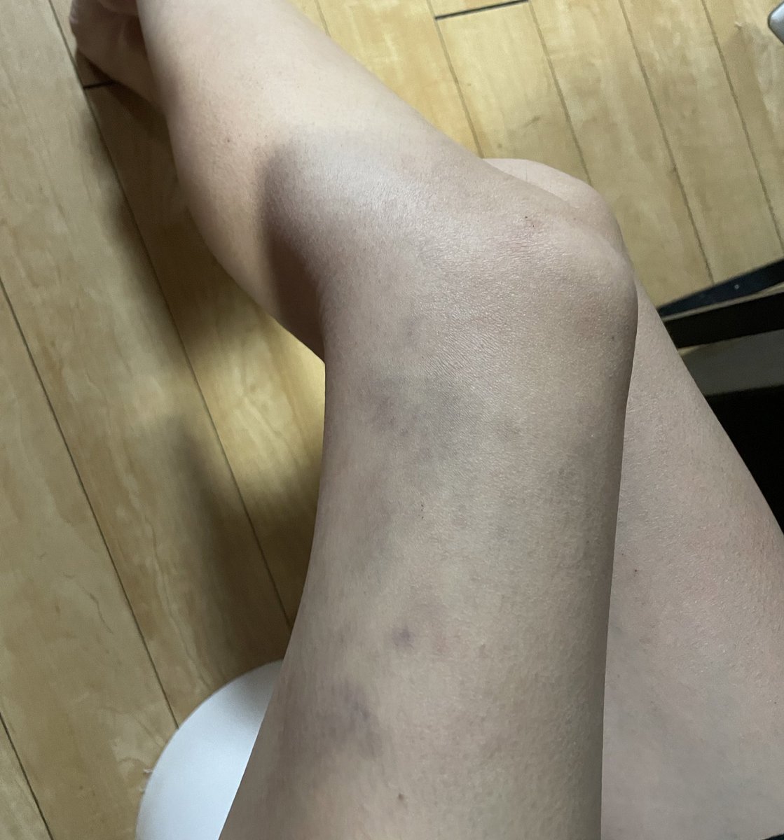 mobuno93's tweet photo. どのタイミングかわからんねんけど

全身大あざまみれやん笑笑

あーーー

行為後の余韻ってやつ？

ホルモン大好き❤ https://t.co/UwybZChr1p